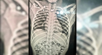 Criança é baleada ao brincar com arma do tio em comunidade Kalunga, na Chapada dos Veadeiros